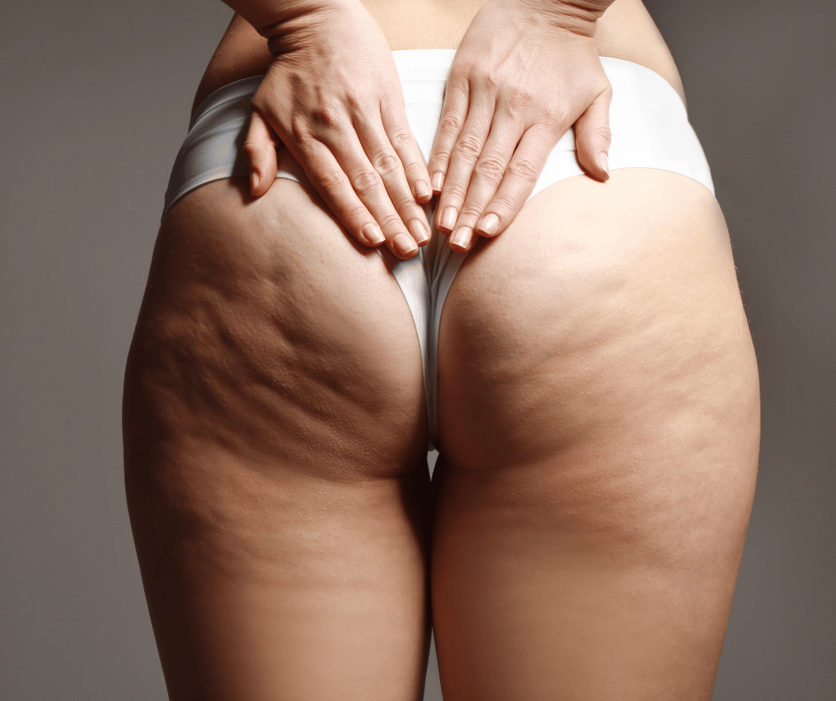 celulitis