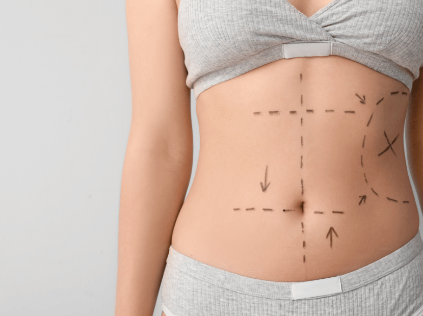 masaje post operatorio LPG Endermoligie