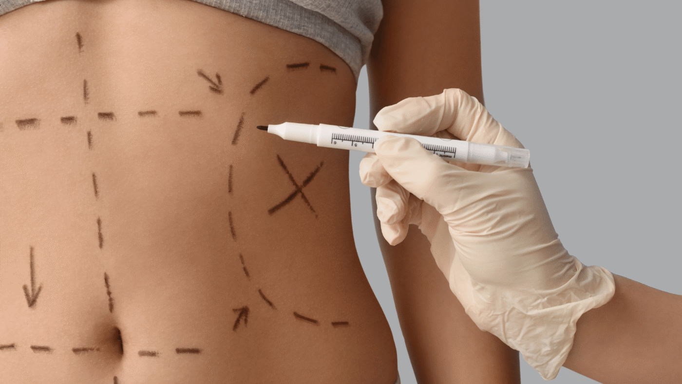 Terapia con LPG Endermologie para preparar el cuerpo antes de una liposucción.